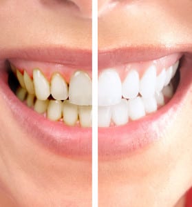 professional-teeth-whitening-thornton-co