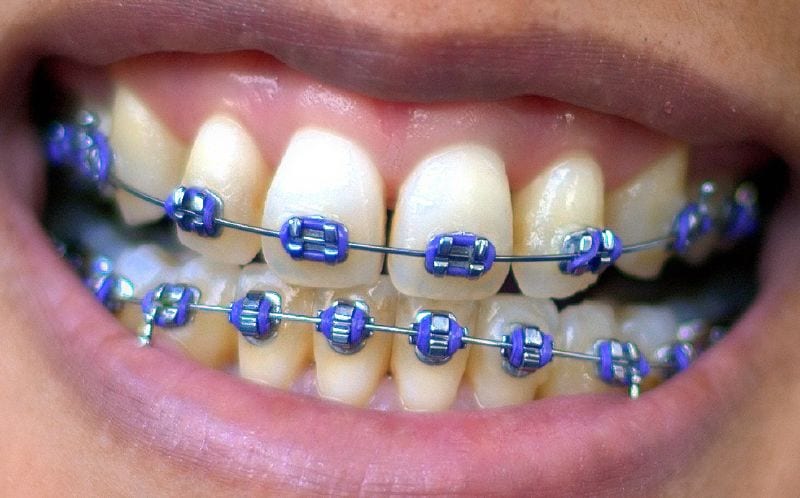 How Much are Dental Braces?  