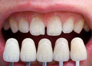 Thornton Dental Veneers